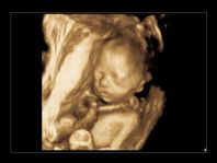 3D-Nabelschnurumschlingung